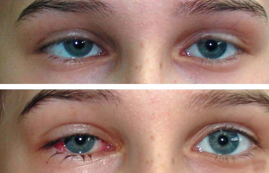 Преди и след лечение Oculax